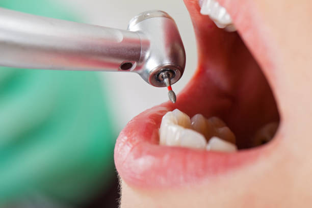 Best Emergency Tooth Extraction in Oviedo, FL